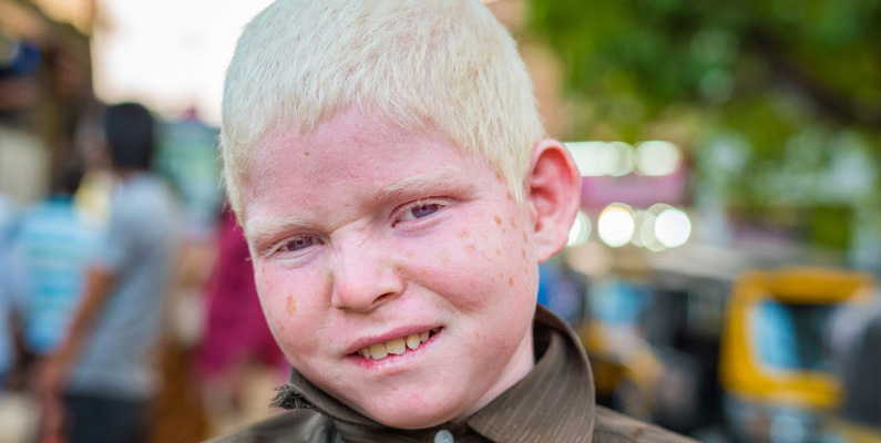 Man kan inte ha "lite" albinism…