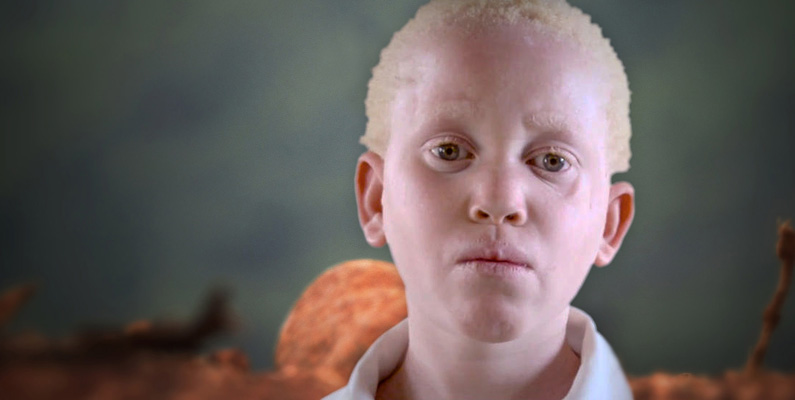 Hudens utveckling hos barn med mild albinism…