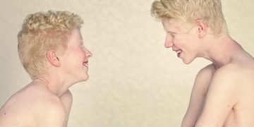 10 fakta du antagligen inte visste om albinism