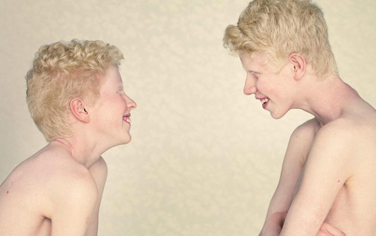 10 fakta du antagligen inte visste om albinism