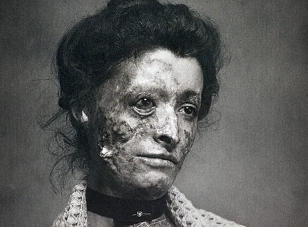 10 historiska foton som kommer att lämna ett starkt intryck på dig:
Viktoriansk kvinna med syfilis…